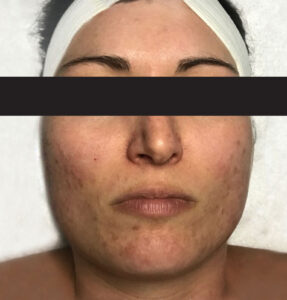 BodyLab Med Spa ©2023 – Clinical Facial – Acne Correction – Before Treatment