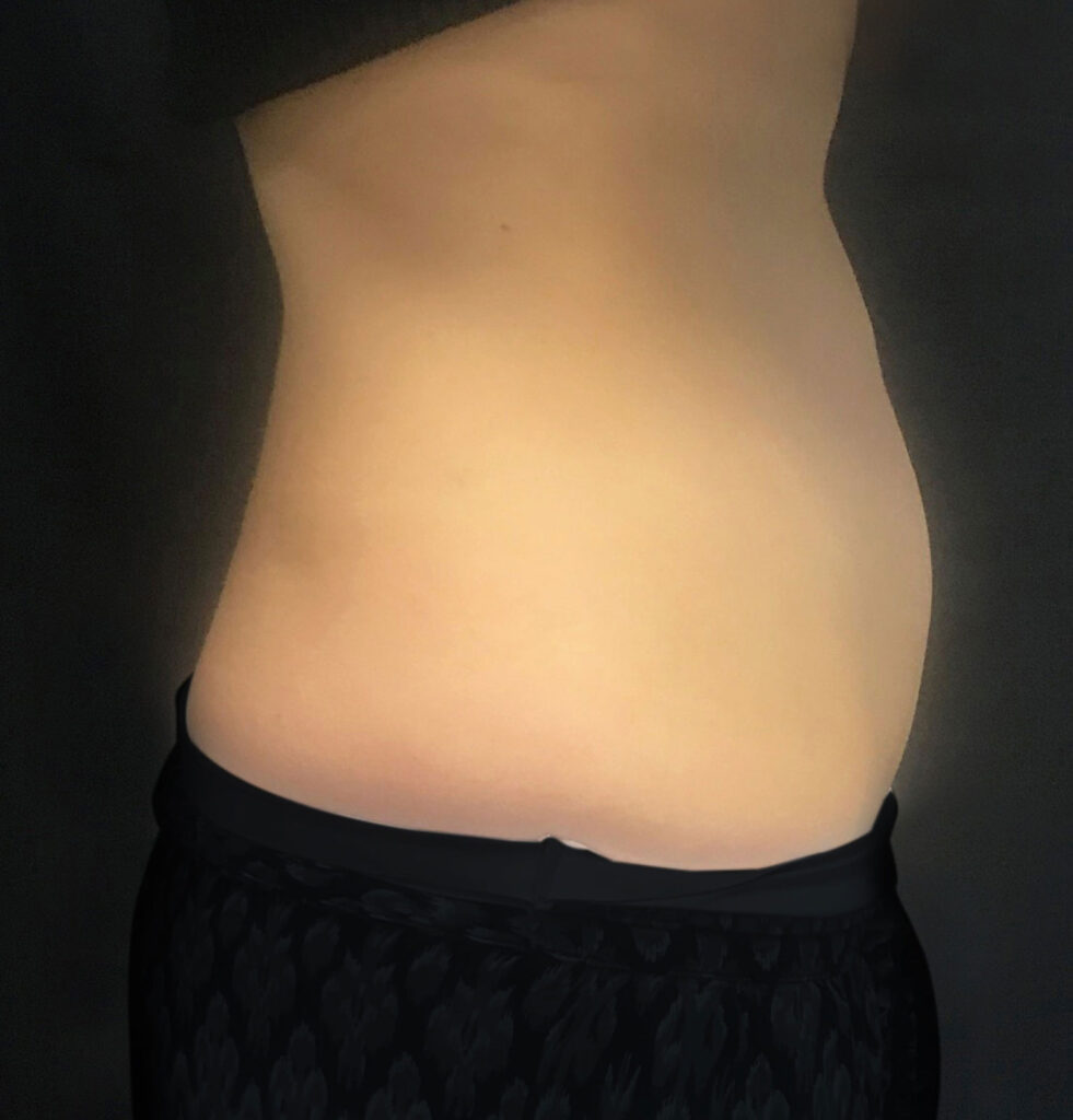 BodyLab Med Spa ©2023 – CoolSculpting® Neck Treatment – After