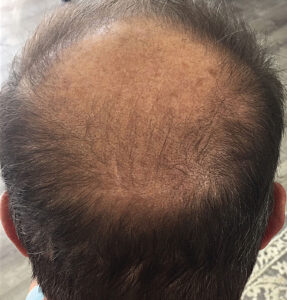 BodyLab Med Spa ©2023 – Hair Restoration After Treatment