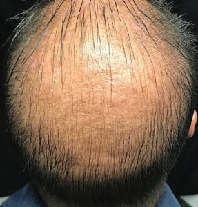 BodyLab Med Spa ©2023 – Hair Restoration Before Treatment