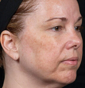 BodyLab Med Spa ©2023 – Laser Skin Resurfacing – Clear + Brilliant – Before Treatment