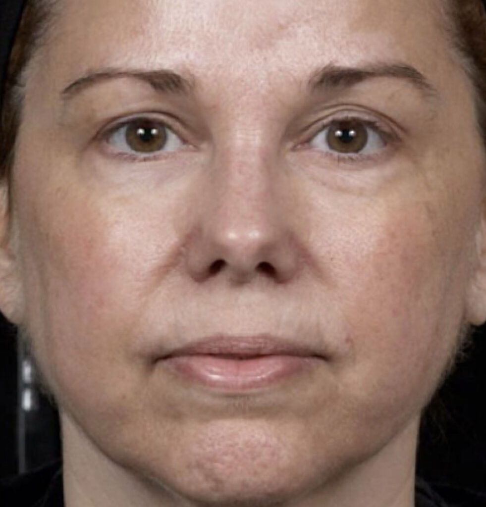 BodyLab Med Spa ©2023 – Laser Skin Resurfacing – Clear + Brilliant – After Treatment