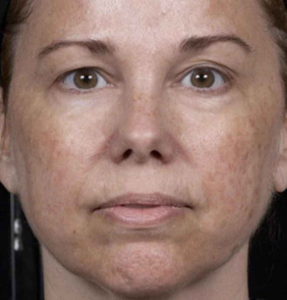 BodyLab Med Spa ©2023 – Laser Skin Resurfacing – Clear + Brilliant – Before Treatment