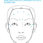 BodyLab Med Spa Botox® Base Injection Diagram