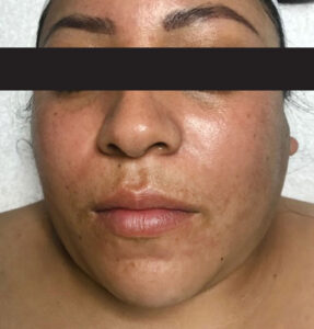 BodyLab Med Spa ©2023 – Clinical Facial – Hyperpigmentation Correction – After Treatment