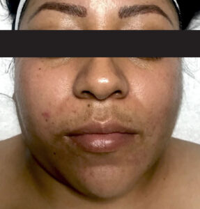 BodyLab Med Spa ©2023 – Clinical Facial – Hyperpigmentation Correction – Before Treatment