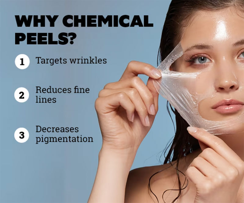 Three reasons why to get a chemical facial peel
