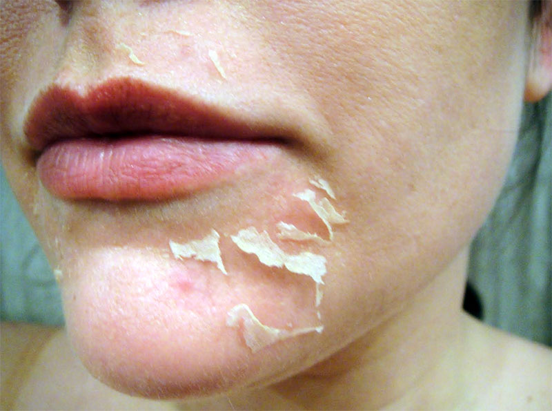Skin peeling on chin
