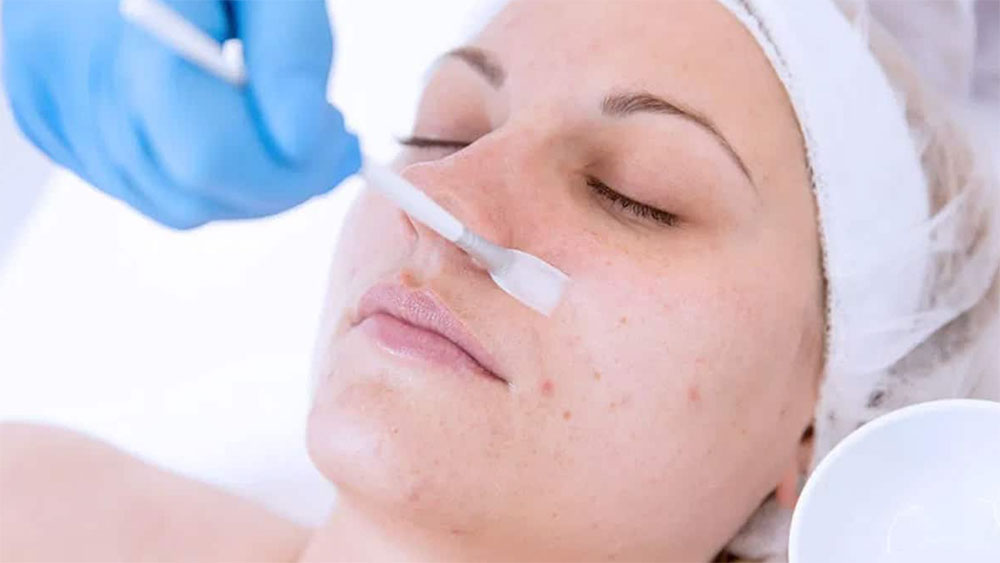 Woman receiving a chemical facial peel