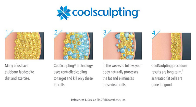 Diagram of how CoolSculpting freezes fat