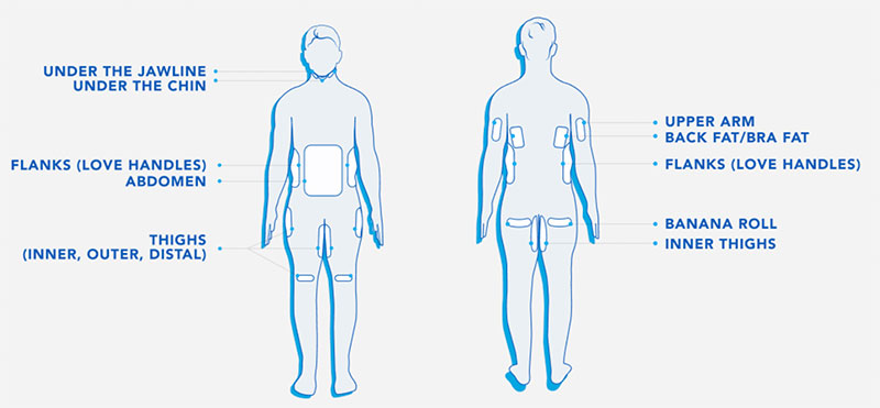 Diagram of CoolSculpting Treatment Areas