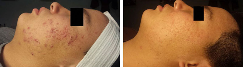 LED Before and After Images on Acne