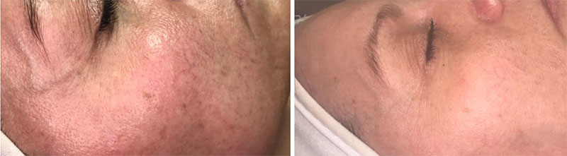 LED Before and After Images on Skin Texture