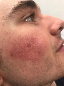 Man's face after a Crystal Depth8 Treatment