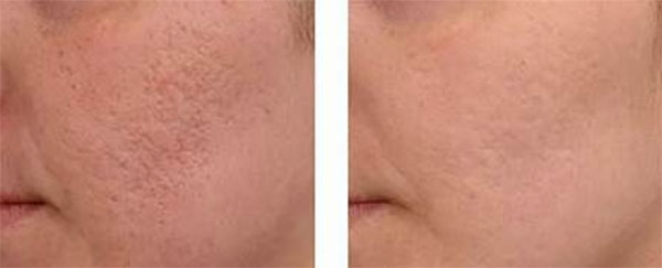 Before and After of a woman's cheek from Crystal Depth8 Treatment