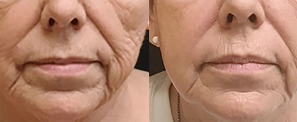 Before and After of a woman's face from Crystal Depth8 Treatment