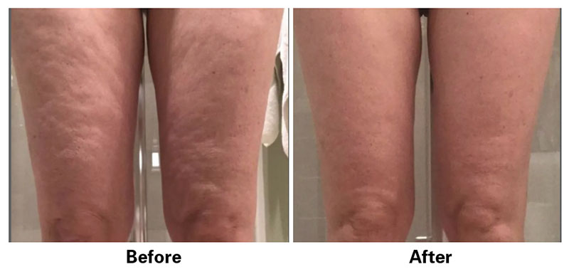 Before and After of woman's legs