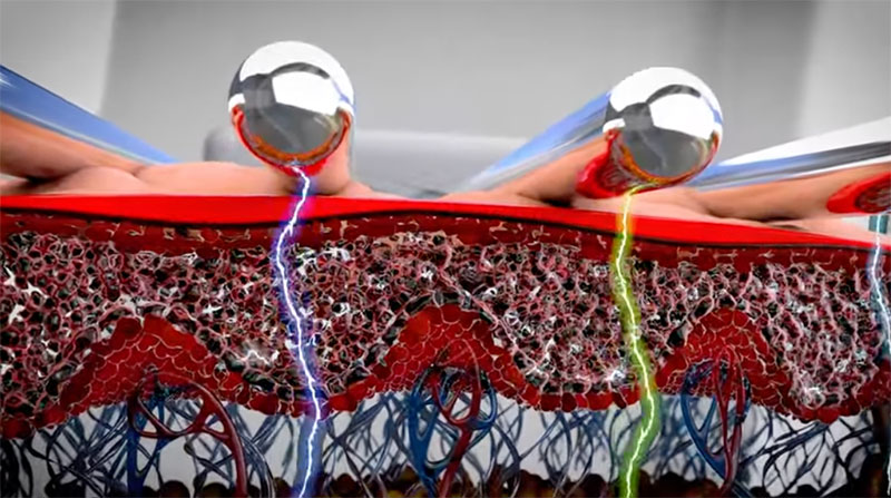 Animated image of Neurotris Microcurrent under skin layers