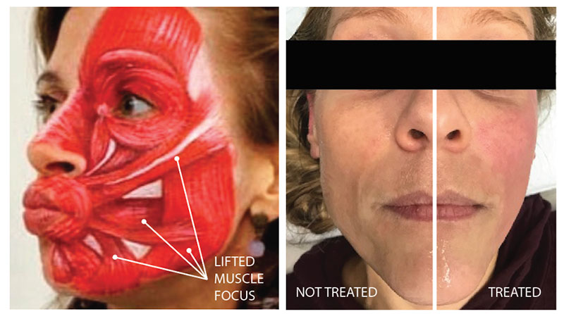 Graphic image of muscles under skin next to a before and after of woman's face