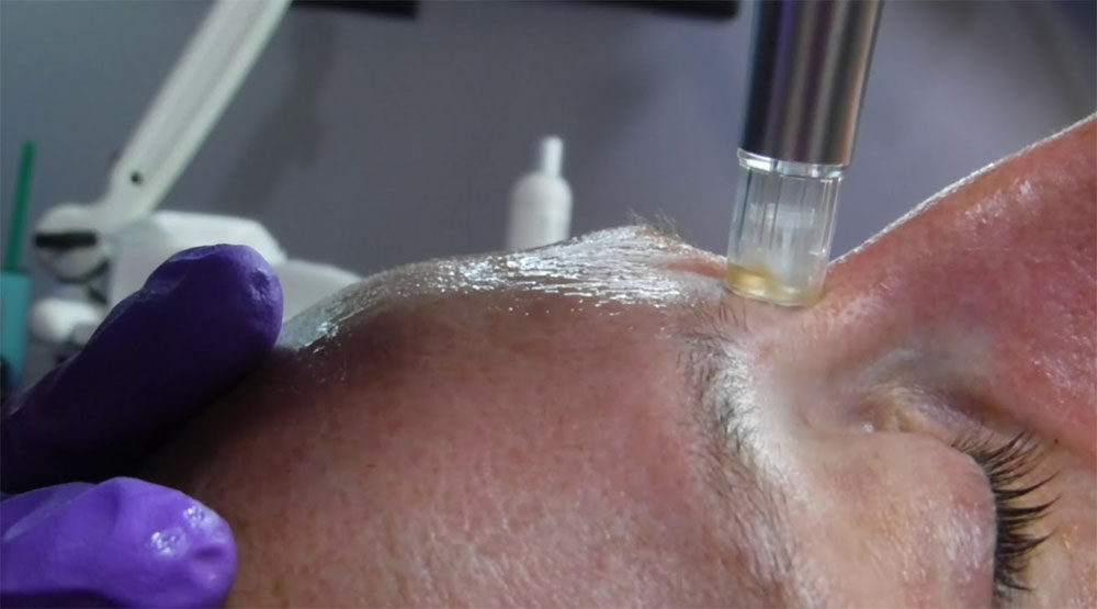 Woman receiving a Rezenerate Microchanneling Facial on forehead