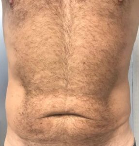 BodyLab Med Spa ©2023 – Crystal Depth 8 – After Treatment