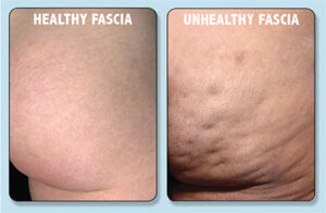 Two images side-by-side of healthy and unhealthy fascia.