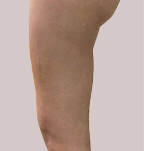 BodyLab Med Spa ©2023 – FasciaRerformer – After Treatment