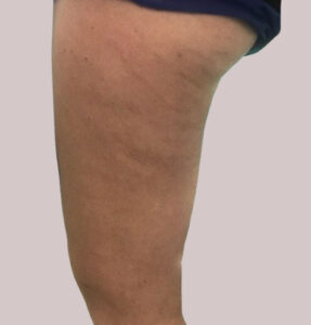 BodyLab Med Spa ©2023 – FasciaRerformer – Before Treatment