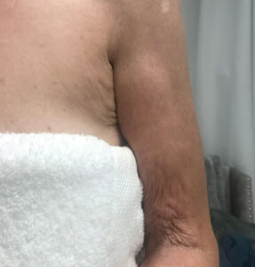 BodyLab Med Spa ©2023 – FasciaRerformer – After Treatment