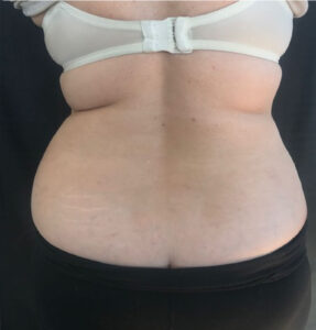 BodyLab Med Spa ©2023 – FasciaRerformer – After Treatment