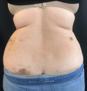 BodyLab Med Spa ©2023 – FasciaRerformer – Before Treatment