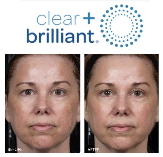 Clear and Brilliant Before & After